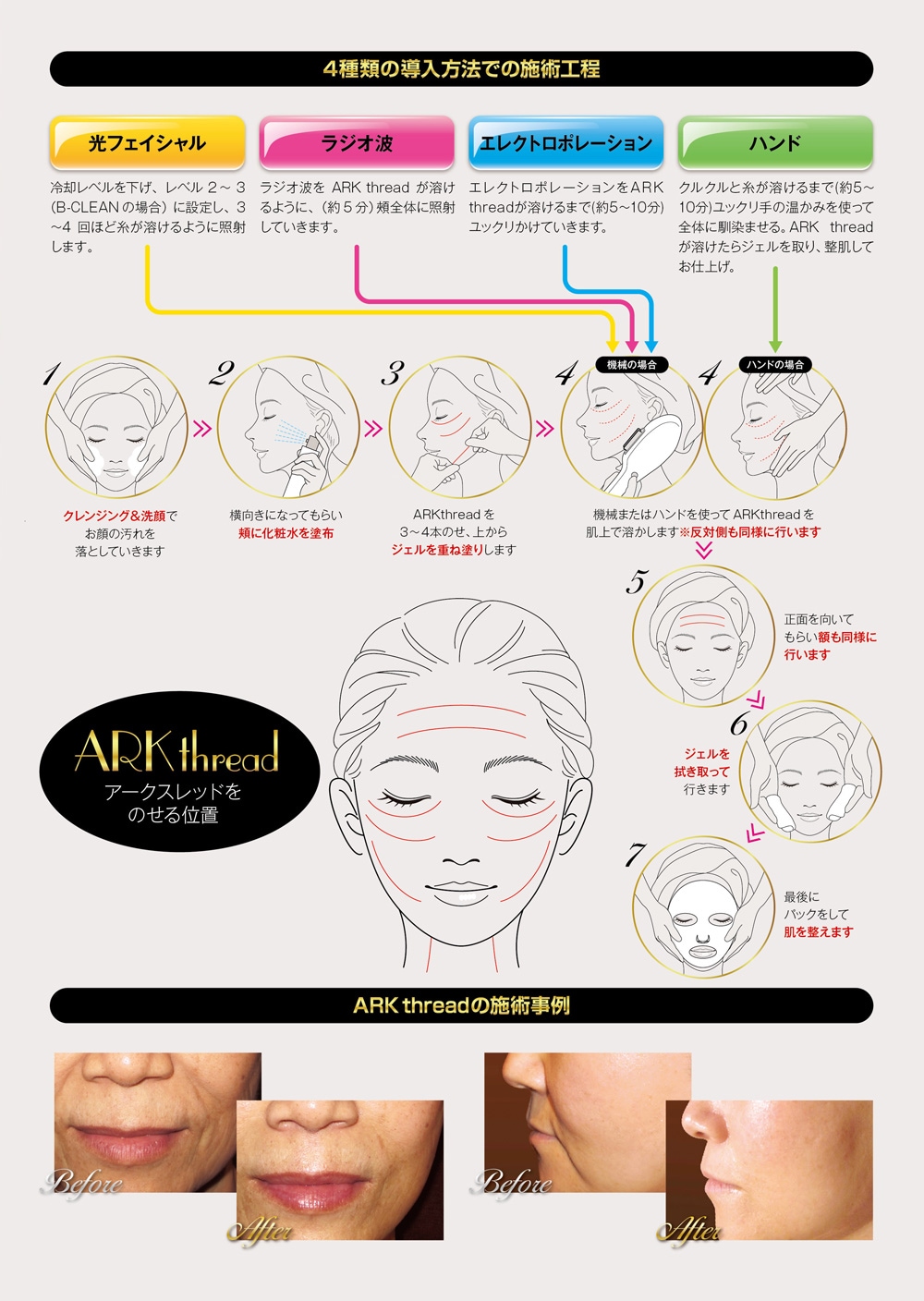 ARKthread[糸リフト](10本) | すべての商品 | | Demi Line