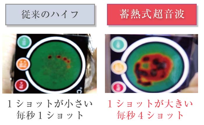 従来のハイフと蓄熱式超音波の違い