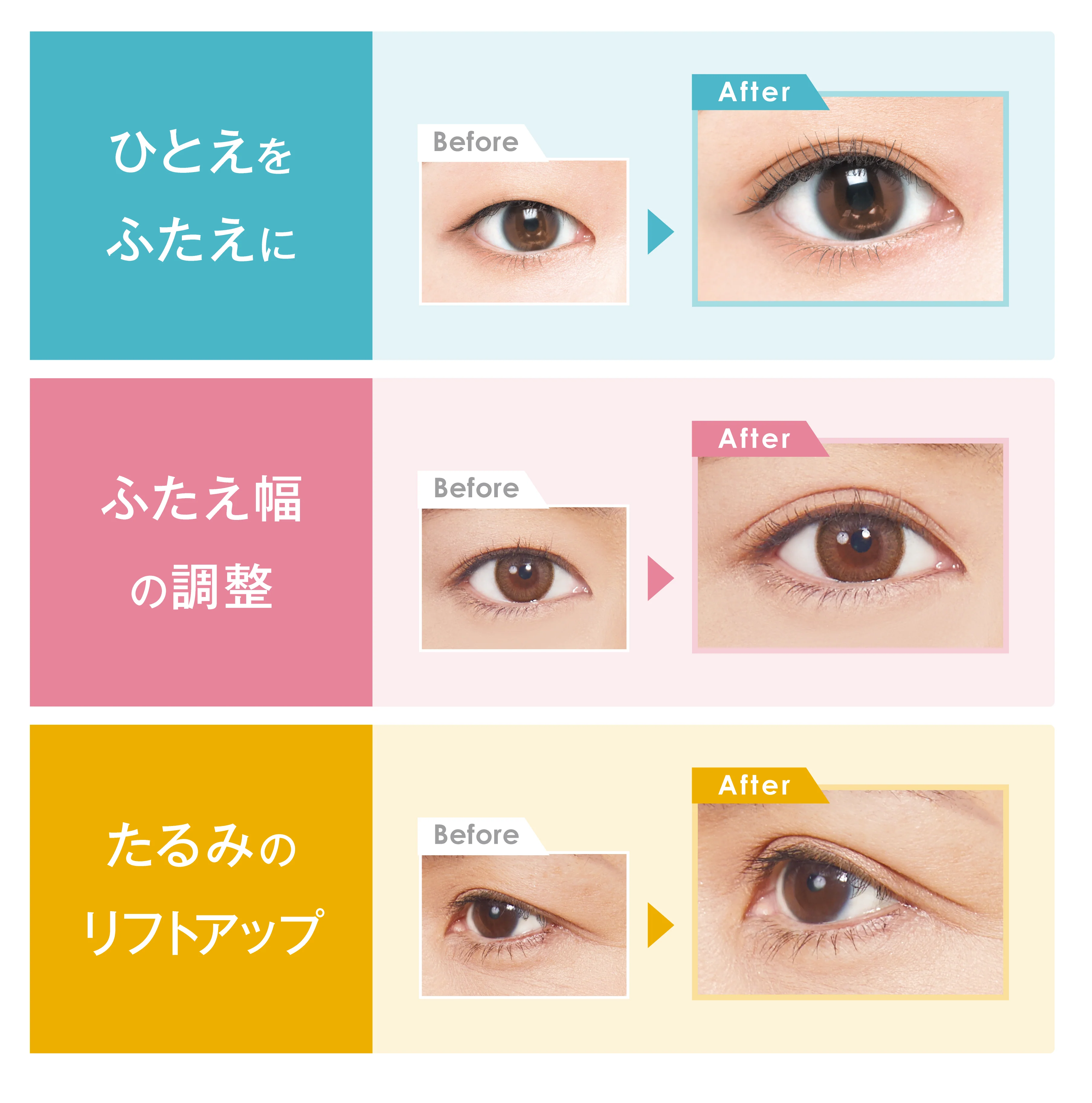 ひとえをふたえに。ふたえ幅の調整。たるみのリフトアップ。 Before After比較