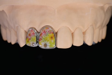 歯を飾るグリルで個性を！初心者向けのかわいいアイテムの選び方