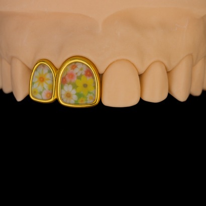 歯のグリルとは？新たなおしゃれのスタイルを知る