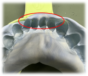 歯と歯ぐきの境目が見えない