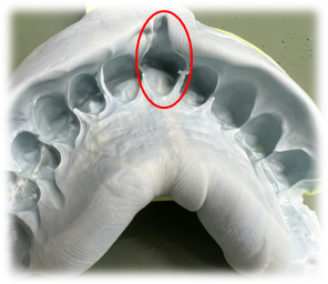 取り外しで引きずり（尾）