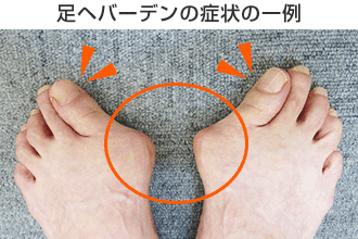 足ヘバーデンの症状の一例