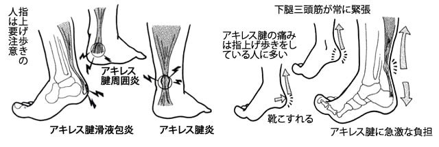 アキレス腱の痛み カサハラ式公式サイト カサハラフットケアショップ