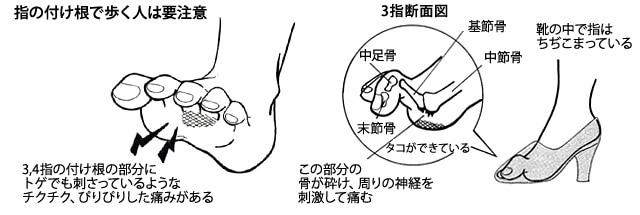付け根 痛み の 指 の 足 の 足の付け根が痛い：医師が考える原因と対処法｜症状辞典