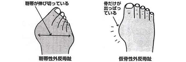 外反母趾の痛み カサハラ式公式サイト カサハラフットケアショップ カサハラ式公式サイト カサハラフットケアショップ