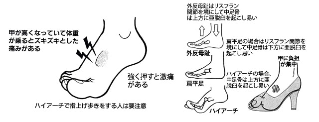 足の甲の痛み カサハラ式公式サイト カサハラフットケアショップ