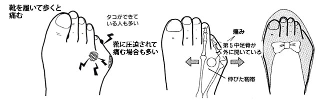 小指の痛み 内反小指 カサハラ式公式サイト カサハラフットケアショップ