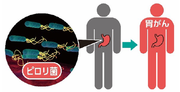 胃がんリスク層別化検査(ABC分類） | デメカルキット | i-cell market