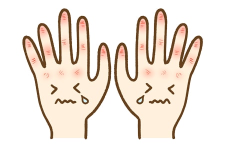 手荒れ対策 角質を保護膜で守る