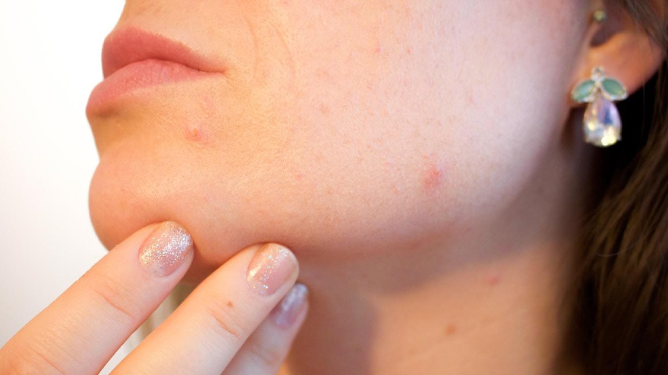 繰り返す大人ニキビのイメージ