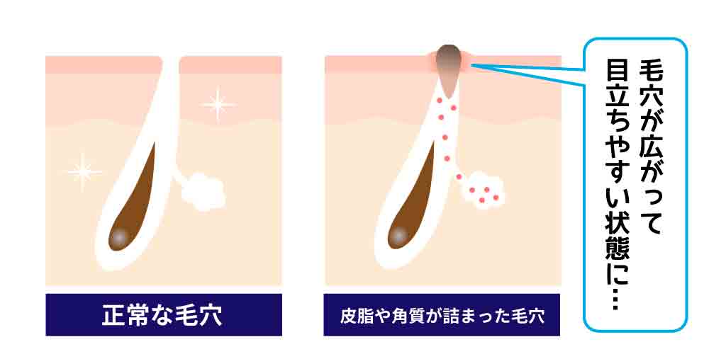 夏に毛穴が目立ちやすい理由