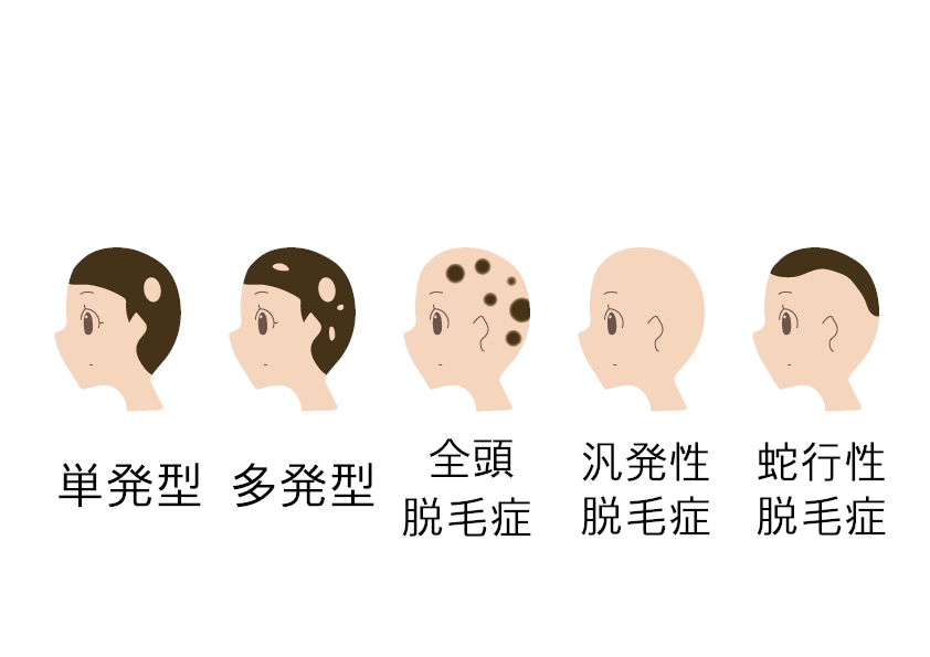 典型的な円形脱毛症の発症タイプは単発型、多発型、全頭脱毛症、汎発性脱毛症、蛇行性脱毛症の5つ