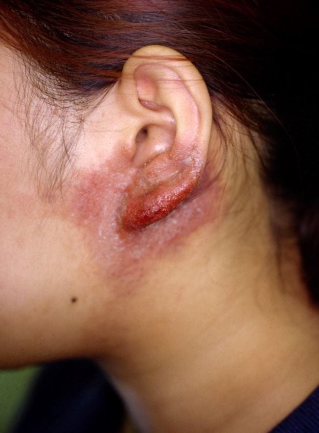 ピアスの金属アレルギー症状の写真　ニッケル（Ni）が原因